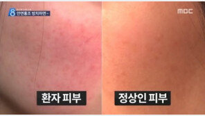 안면홍조 예방법, ‘홍당무’ 탈출하려면 이것 피하라?