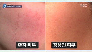 안면홍조 예방법, 얼굴 갑자기 왜 빨개지나?