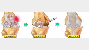 [Health&Beauty]무릎 줄기세포 치료받고 등산도 거뜬히…