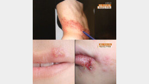 대상포진 예방법, 예방접종이 가장 확실… 방치하면 평생 고생