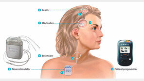[Health&Beauty/첨단의학을 달린다]신경에 미세한 전기자극 줘 치료한다