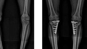 [Health&Beauty]휜 다리 교정, 관절염 치료 병행하면 효과 커 