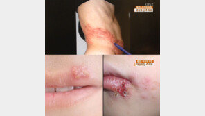 여성 대상포진 환자 증가, 남성보다 1.5배 많아… 이유는?