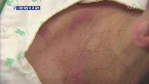 저온 화상 주의, 본인도 모르는 사이 피부색이 하얗게...