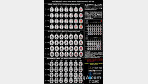 뇌경색 위험 예측지도 발표, 약 6만 장의 뇌 MRI 하나하나 분석