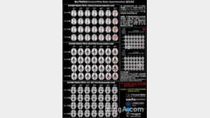 국내 연구진, 뇌경색 예측 지도 완성… 뇌 건강나이 추정 가능