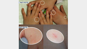 어린이집 바늘 학대 피해 아동 3→6명 늘어나… 바늘 별명 ‘착한 바늘’ 충격