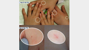 어린이집 바늘 학대, 의사 아이들 손 보더니 “오래전부터 입은 상처다”