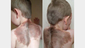 등에 날개가? 희귀 피부질환 앓는 2세 ‘아기 천사’ 사연