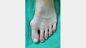 키높이 뾰족구두에… 男도 ‘하이힐病’ 