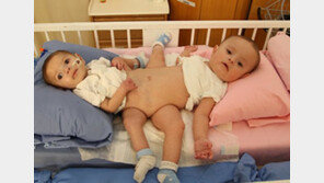 장(腸)-비뇨기관 공유한 샴쌍둥이, 9시간의 분리수술 끝에…