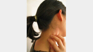 ‘편평사마귀 유행’ 타인과 접촉을 통해 감염...발병시 어떤 증세? 