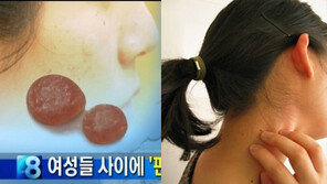 ‘편평사마귀 유행’ 20대女, 여드름인줄 알고 짜다 그만 “흉터 어떡하나”…완치법은?