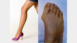 무지외반증 남성환자 급증, 女 하이힐병 NO! 男 구두 변화로 인해…