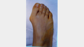 무지외반증 남성환자 급증, 신발 트렌드와 체형변화가 원인?