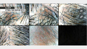‘노푸’ 열풍이란 극 과 극? 피부과 의사 “샴푸로 머리 감아라”