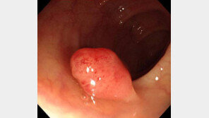 대장암으로 이어질 수 있는 선종성 용종 환자 증가…원인은 무엇?