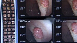 대장암 전단계 선종성 용종 급증, 60대 남성 ‘주의’… 원인은?