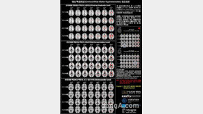 당뇨병 환자의 아스피린 복용, 뇌경색 위험 증가… 정례화될까?