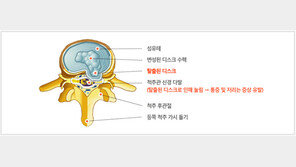 가벼운 허리통증땐 약물·F1치료 효과적