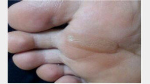 티눈 환자 증가, 치료하지 않으면 ‘궤양에 혈관염까지’