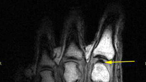 손가락관절 ‘두두둑’… 공기 밀려들어가는 소리