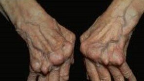 류마티스관절염은 노화가 아닌 면역력의 문제
