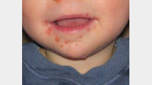 수족구병 이른 유행, 손·발·얼굴에 빨간 수포자국...개발된 백신 없어 주의 필요