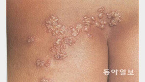 ‘통증의 왕’ 대상포진, 젊은 층 빈발… 치료 및 예방법은?