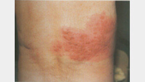 ‘출산보다 더 심한 통증’ 대상포진, 젊은 층서 빈발…여름철 환자 ‘↑’