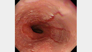 역류성 식도염 원인은? 가볍게 여기고 방치하면 식도암으로 발전할 수 있어...
