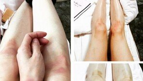 ‘미세스 캅’ 열연 이다희, SNS 통해 멍든 다리 사진 공개 “액션씬 은근 중독 인듯~!”