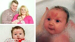 생후 12주 아기 이마에 ‘♡’ 모양 점 ‘진정한 밸런타인데이 선물’