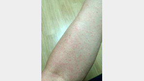 국내 첫 지카바이러스 환자 퇴원, 질본 “지역사회 추가 전파 가능성 극히 낮다”