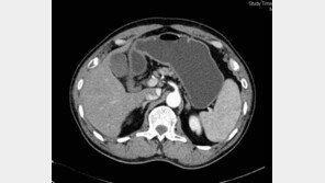위암 연구자료 분석해보니…“3대 위험요인은 과음·가공육 과다섭취·○○”