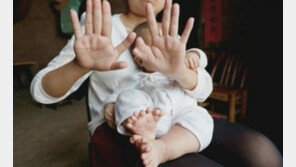 손·발가락 ‘총 31개’ 갖고 태어난 사내 아이, “어떡해” 