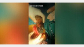 20년간 머리카락 씹어먹은 女, 위에 3kg짜리 머리카락 뭉치가… 