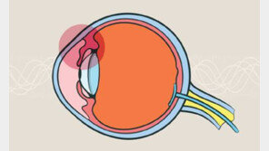 [Health&Beauty]눈에 포도막염 재발 잦다면… 강직척추염