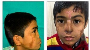 돌팔이 시술로 코 잃은 소년, 이마 위에 새 코가 ‘쑥’?!