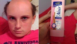 제모제를 샴푸로 잘못 알고 써 대머리 된 여성 사진 온라인서 확산