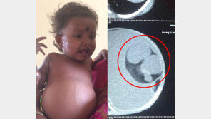 배 속에 쌍둥이 품고 태어난 여아…기생체 1년 간 3.5kg까지 성장 ‘충격’