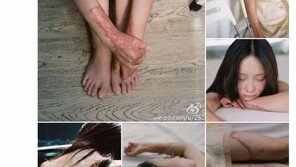 구애 거절했다 전신 화상 입은 여대생 근황 공개…응원 봇물