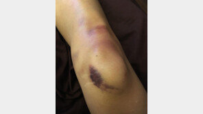 이시영 ‘무릎 피멍’ 공개, 어쩌다?…“이런 컬러 처음, 고급스러운 자줏빛” 