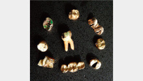 치과에서 뽑은 내 금니는 어디로?