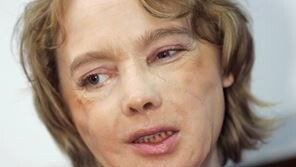 세계 첫 안면이식 佛 여성 11년만에 사망…“기증자 얼굴 뒤섞인 모습에 혼란”