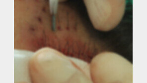 모발이식수술 안받았는데 내 사진이 왜…법원, 상담 사진 무단 사용 의사 등에 “600만 원 배상하라”