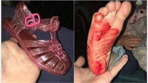 젤리슈즈 신은 여아 발 피범벅…안전성 논란 ‘재점화’