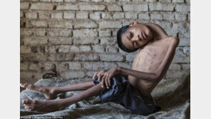 목 굽어 얼굴이 가슴에 닿았던 13세 소년 “수술 후 새 삶 찾아”