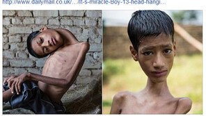 목 180도 꺾였던 소년, 수술로 새 삶 찾았지만…8개월만에 사망