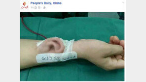 팔뚝에서 자란 ‘사람 귀’…사고로 귀 잃은 男, 이식수술로 새 삶 꿈 꿔